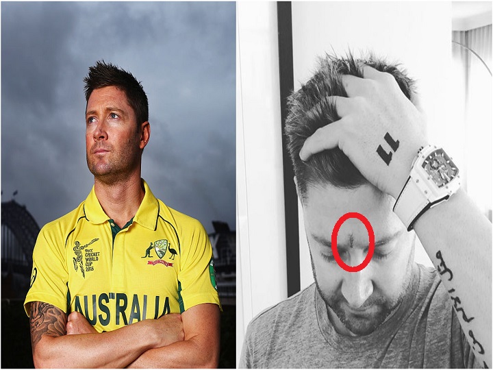 michael clarke gets skin cancer removed shares picture माइकल क्लार्क के माथे पर हुए स्किन कैंसर को हमेशा के लिए हटाया गया, क्रिकेटर ने सोशल मीडिया पर शेयर की तस्वीर